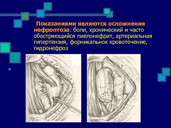 Показаниями являются осложнения нефроптоза: боли, хронический и часто обостряющийся