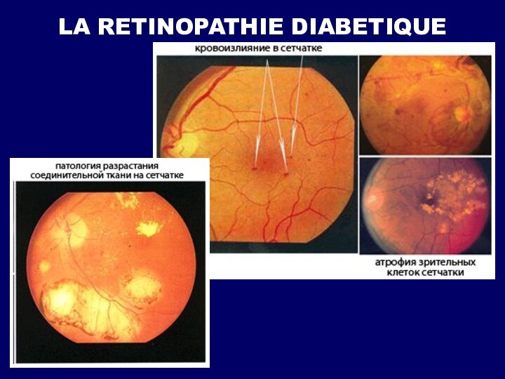 LA RETINOPATHIE DIABETIQUE