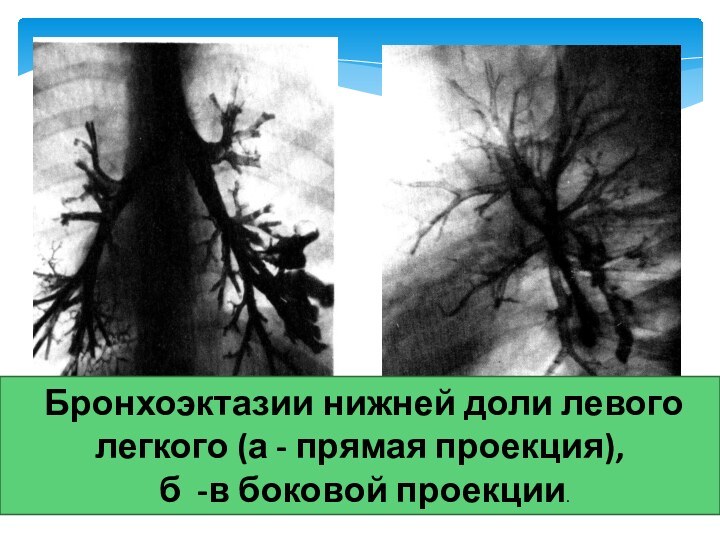 Бронхоэктазии нижней доли