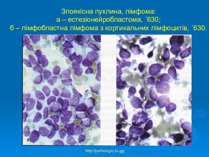 Злоякісна пухлина, лімфома:  а – естезіонейробластома, ´630;  б – лімфобластна