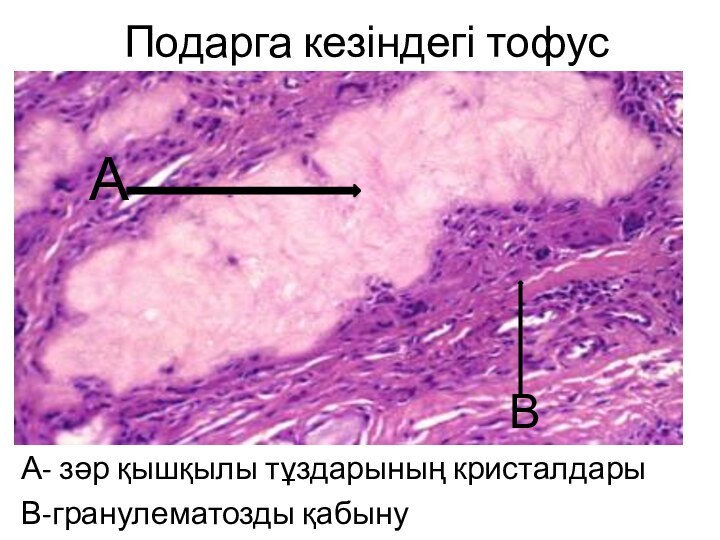 Подарга кезіндегі тофусА- зәр қышқылы тұздарының кристалдарыВ-гранулематозды қабынуВА