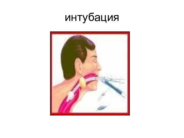 интубация