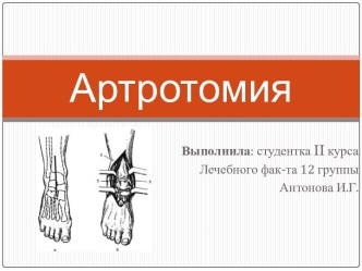 Операция вскрытия или обнажения сустава - артротомия