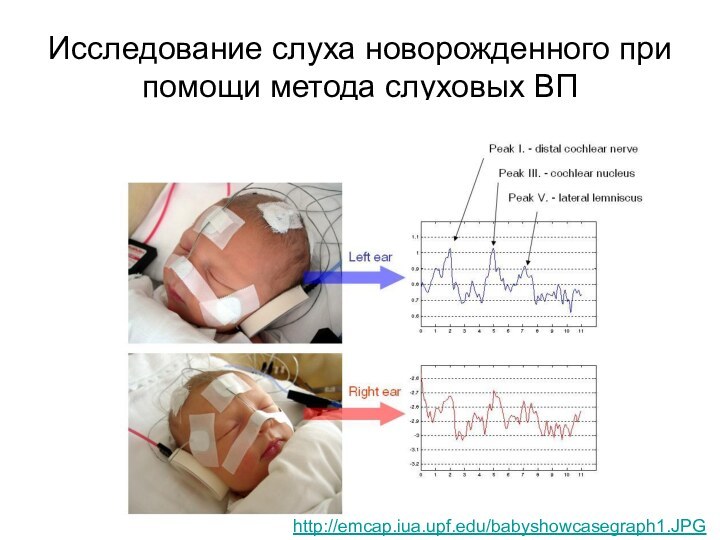 Исследование слуха новорожденного при помощи метода слуховых ВПhttp://emcap.iua.upf.edu/babyshowcasegraph1.JPG