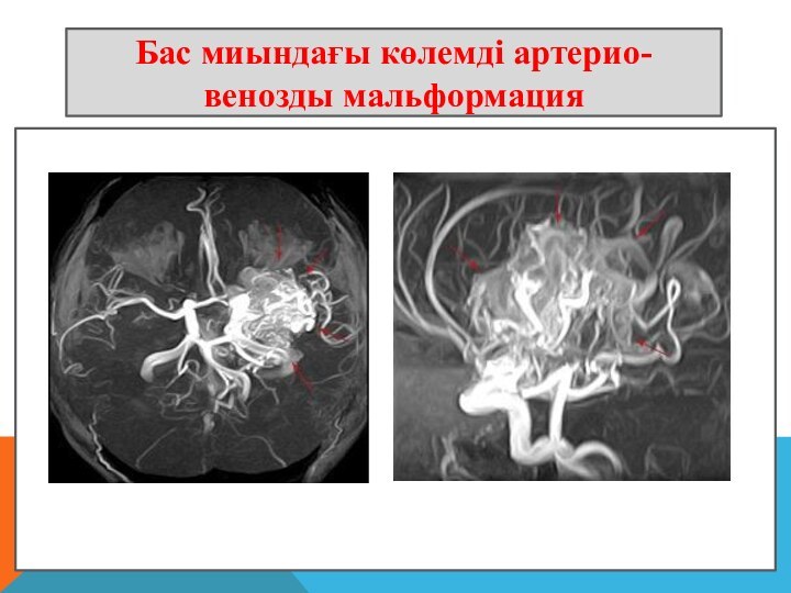 Бас миындағы көлемді артерио-венозды мальформация