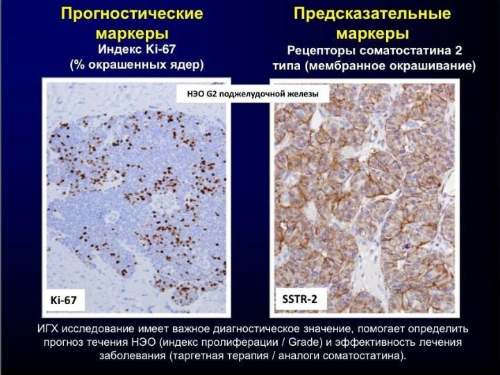 Нейроэндокринные опухоли презентация