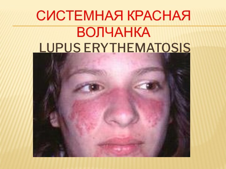 СИСТЕМНАЯ КРАСНАЯ ВОЛЧАНКА  LUPUS ERYTHEMATOSIS