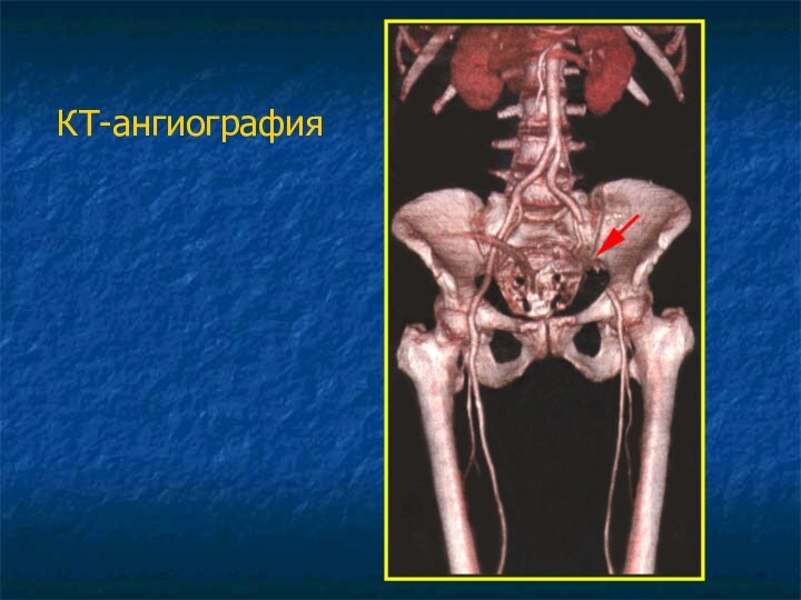 КТ-ангиография