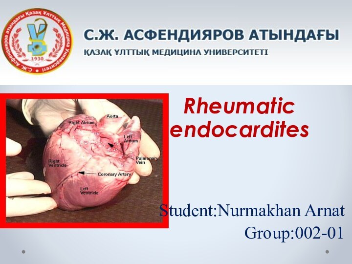 Rheumatic   endocarditesStudent:Nurmakhan ArnatGroup:002-01