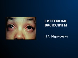 Системные васкулиты