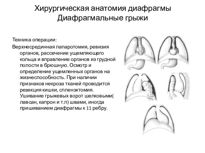 Хирургическая анатомия диафрагмы Диафрагмальные грыжи