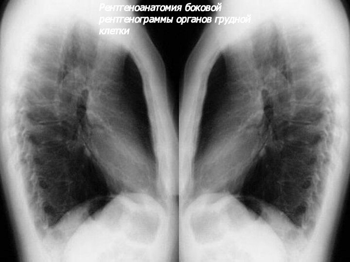 Рентгеноанатомия боковой рентгенограммы органов грудной клетки