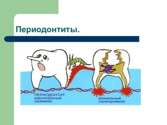 Периодонтиты. Классификация периодонтитов