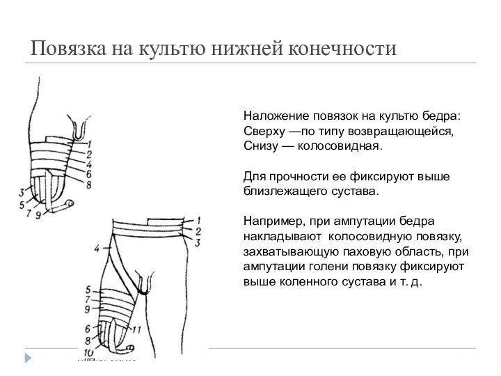 Повязка на культю нижней конечностиНаложение повязок на культю бедра:Сверху —по типу возвращающейся,