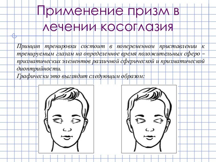 Применение призм в лечении косоглазияПринцип тренировки состоит в попеременном приставлении к тренируемым