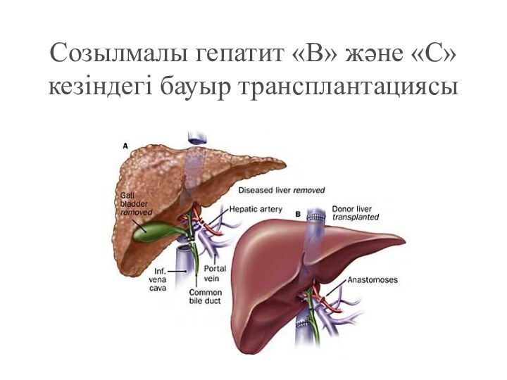 Созылмалы гепатит «В» және «С» кезіндегі бауыр трансплантациясы