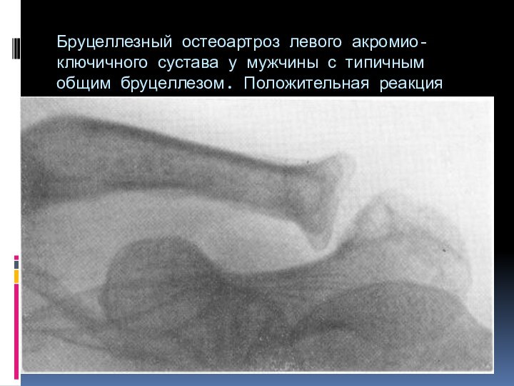 Бруцеллезный остеоартроз левого акромио-ключичного сустава у мужчины с типичным общим бруцеллезом. Положительная реакция Бюрне.