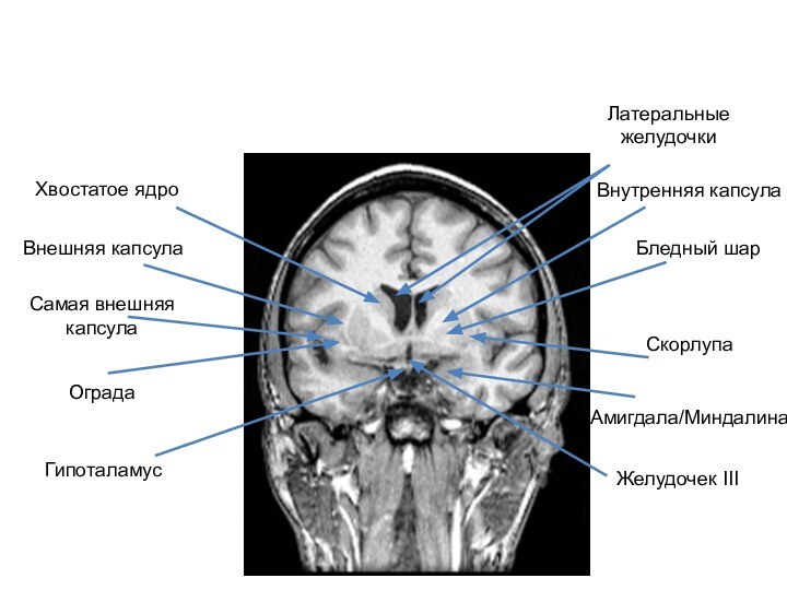 Внутренняя капсулаВнешняя капсулаСамая внешняя капсулаОградаХвостатое ядроБледный шарСкорлупаЛатеральные желудочкиГипоталамусЖелудочек IIIАмигдала/Миндалина