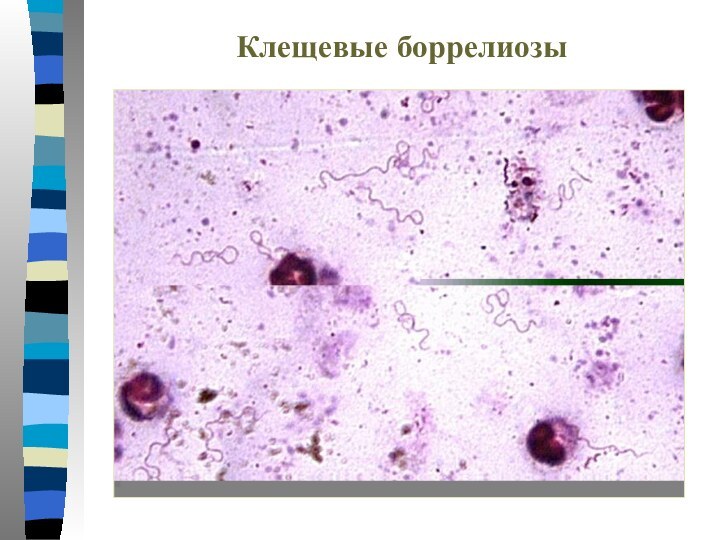 Клещевые боррелиозы