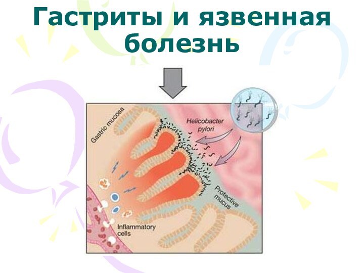 Гастриты и язвенная болезнь