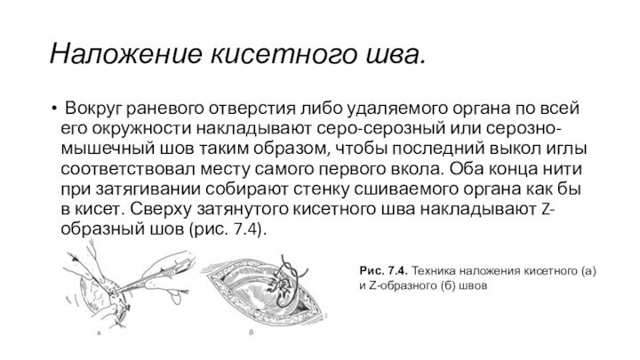 Наложение кисетного шва. Вокруг раневого отверстия либо удаляемого органа по всей его окружности