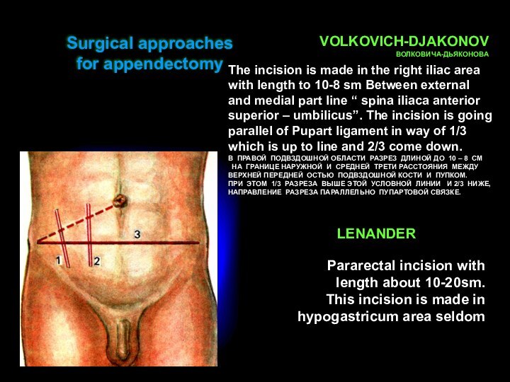 VOLKOVICH-DJAKONOVВОЛКОВИЧА-ДЬЯКОНОВАThe incision is made in the right iliac area with length to