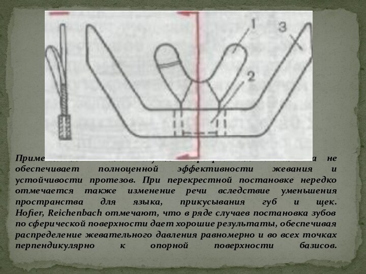 Применяемая в таких случаях перекрестная постановка не обеспечивает полноценной эффективности жевания и