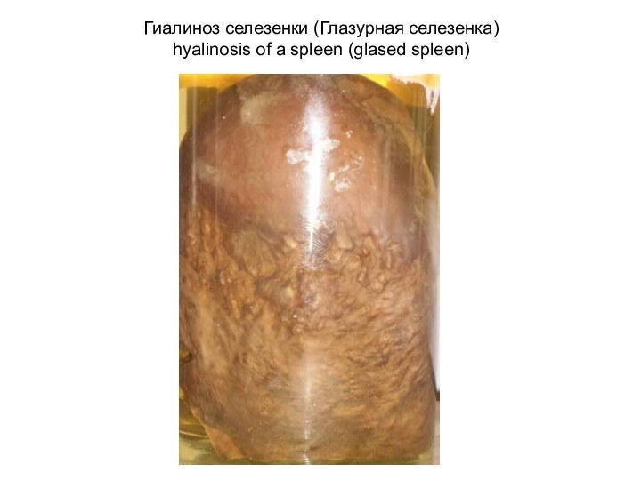 Гиалиноз селезенки (Глазурная селезенка)  hyalinosis of a spleen (glased spleen)