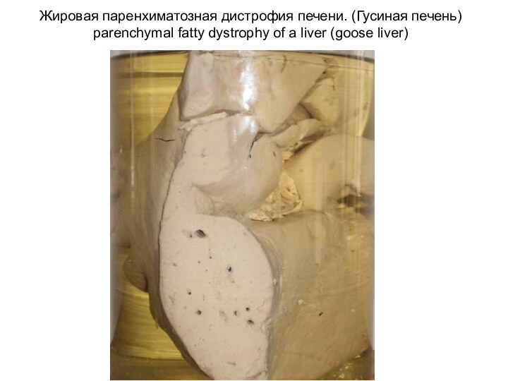 Жировая паренхиматозная дистрофия печени. (Гусиная печень) parenchymal fatty dystrophy of a liver (goose liver)