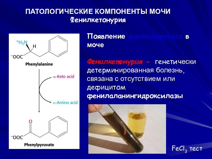 Появление фенилпирувата в мочеФенилкетонурия - генетически детерминированная болезнь, связана с отсутствием или