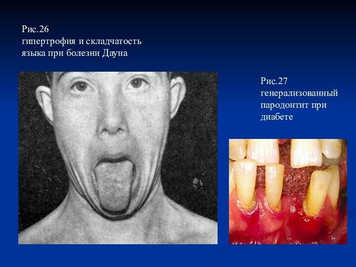 Рис.26гипертрофия и складчатость языка при болезни ДаунаРис.27генерализованный пародонтит при диабете