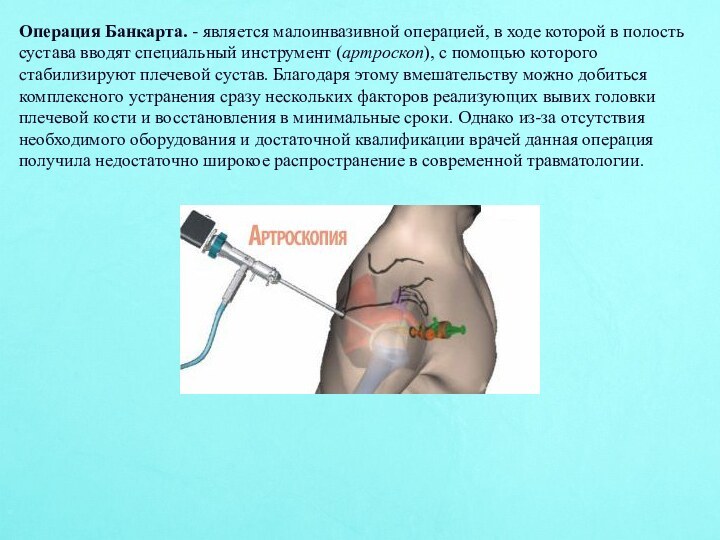 Операция Банкарта. - является малоинвазивной операцией, в ходе которой в полость сустава