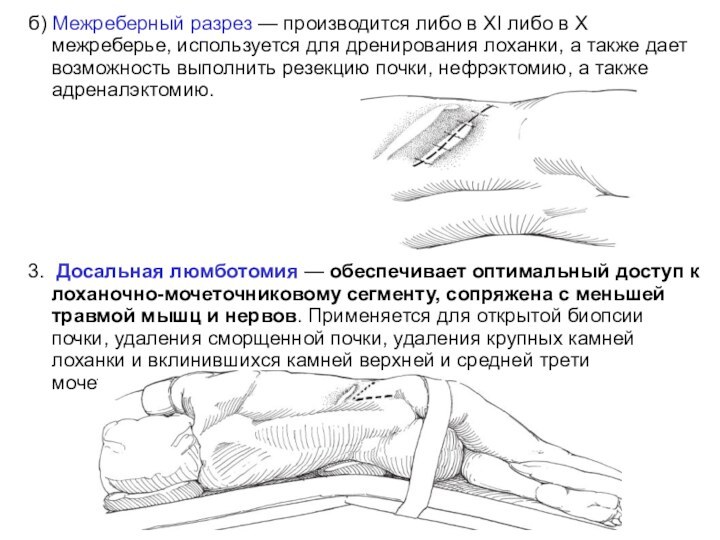 б) Межреберный разрез — производится либо в XI либо в X межреберье,