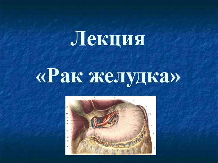 Лекция «Рак желудка»