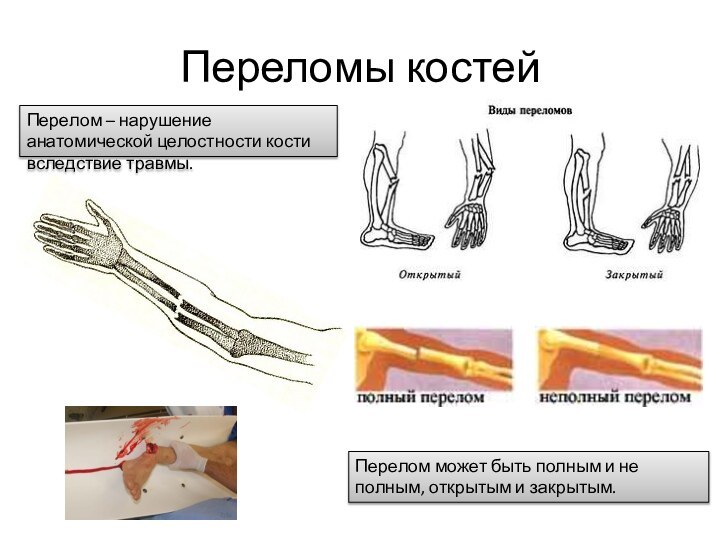 Переломы костей Перелом – нарушение анатомической целостности кости вследствие травмы. Перелом может