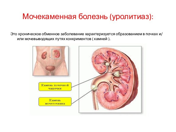 Мочекаменная болезнь (уролитиаз):Это хроническое обменное заболевание характеризуется образованием в почках и/ или