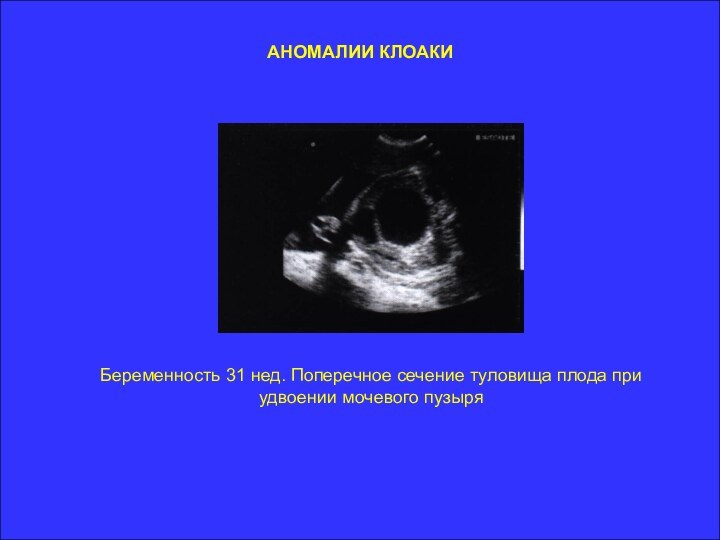 АНОМАЛИИ КЛОАКИБеременность 31 нед. Поперечное сечение туловища плода при удвоении мочевого пузыря