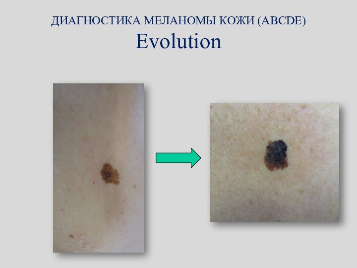 ДИАГНОСТИКА МЕЛАНОМЫ КОЖИ (ABCDE) Evolution