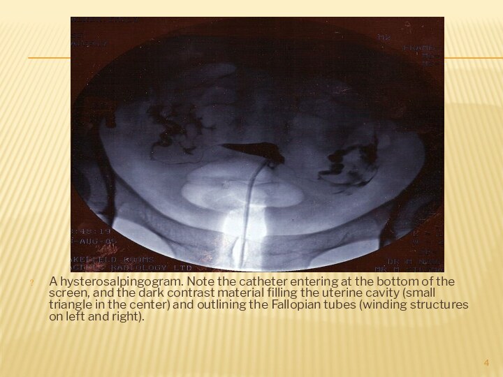 A hysterosalpingogram. Note the catheter entering at the bottom of the