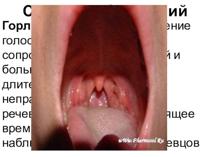 Стигмы заболеванийГорло священника - воспаление голосовых связок,сопровождающееся хрипотой и болью в горле