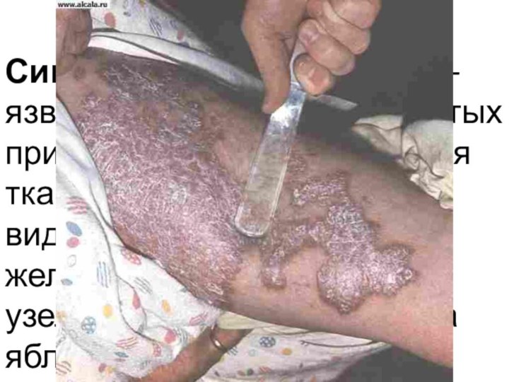 ТуберкулезСимптом яблочного желе—язвенное поражение слизистых при туберкулезе- пораженная ткань бледнеет, становятся видимыми