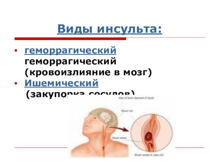 Виды инсульта:геморрагический геморрагический (кровоизлияние в мозг) Ишемический  (закупорка сосудов)