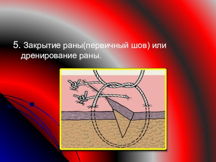 5. Закрытие раны(первичный шов) или дренирование раны.