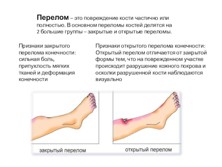 Переломы костей голени тест нмо