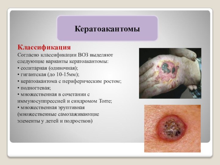 КератоакантомыКлассификацияСогласно классификации ВОЗ выделяют следующие варианты кератоакантомы: • солитарная (одиночная); • гигантская