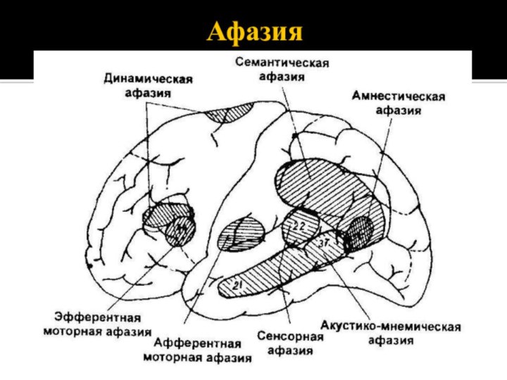 Афазия