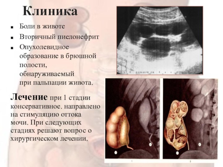 КлиникаБоли в животеВторичный пиелонефрит Опухолевидное образование в брюшной полости, обнаруживаемый при пальпации живота.Лечение при 1 стадии