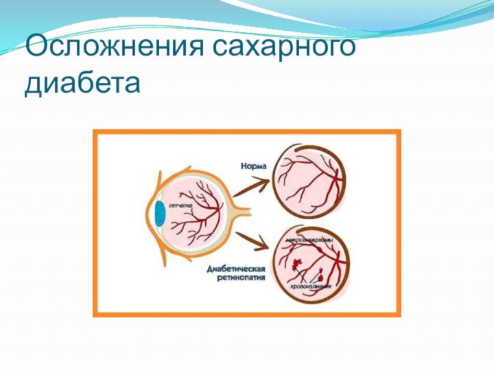 Осложнения сахарного диабета