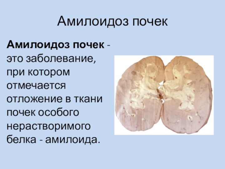 Амилоидоз почекАмилоидоз почек - это заболевание, при котором отмечается отложение в ткани
