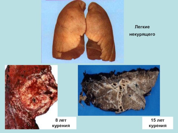 15 лет курения8 лет куренияЛегкие некурящего